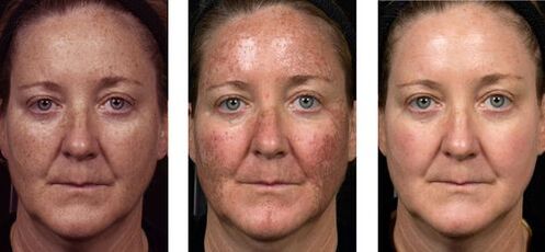 vor und nach der fraktionierten Hautverjüngung Foto 2