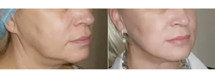 Erholung nach Hautverjüngung