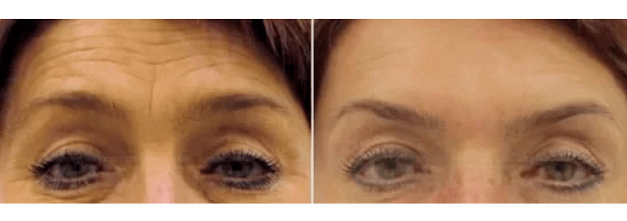 Geräte zur fraktionierten Verjüngung