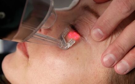 Verfahren zur Gesichtshautverjüngung mit Laser
